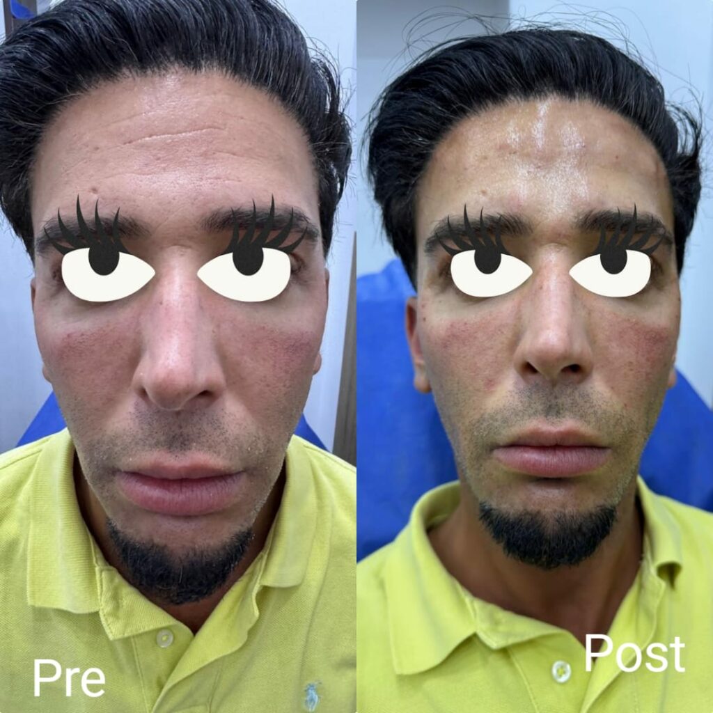 Botox for men's faces